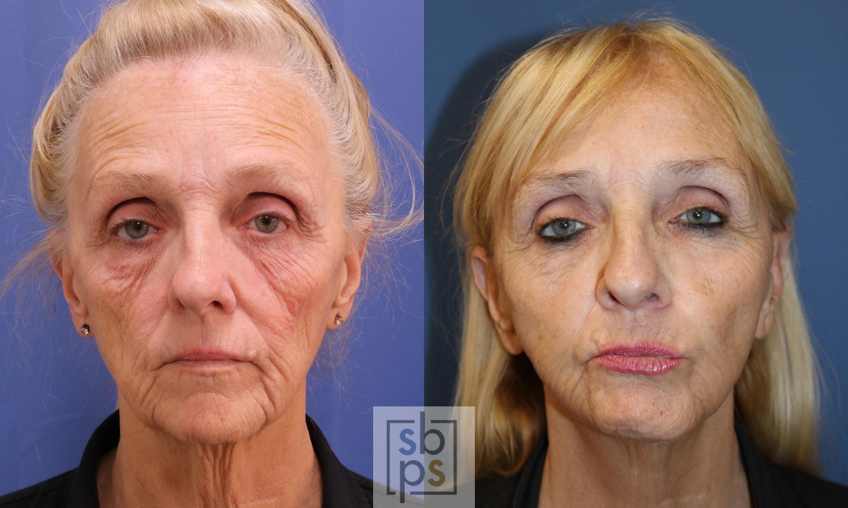 Before & After Facelift Case 345 View #1 View in Torrance, CA