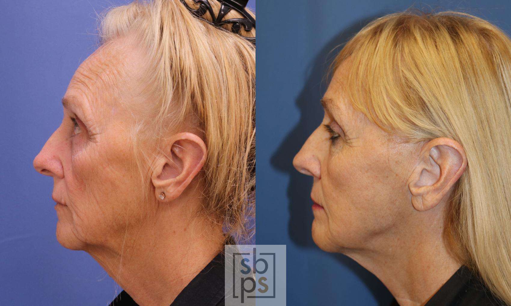 Before & After Facelift Case 345 View #2 View in Torrance & Los Angeles, CA, CA