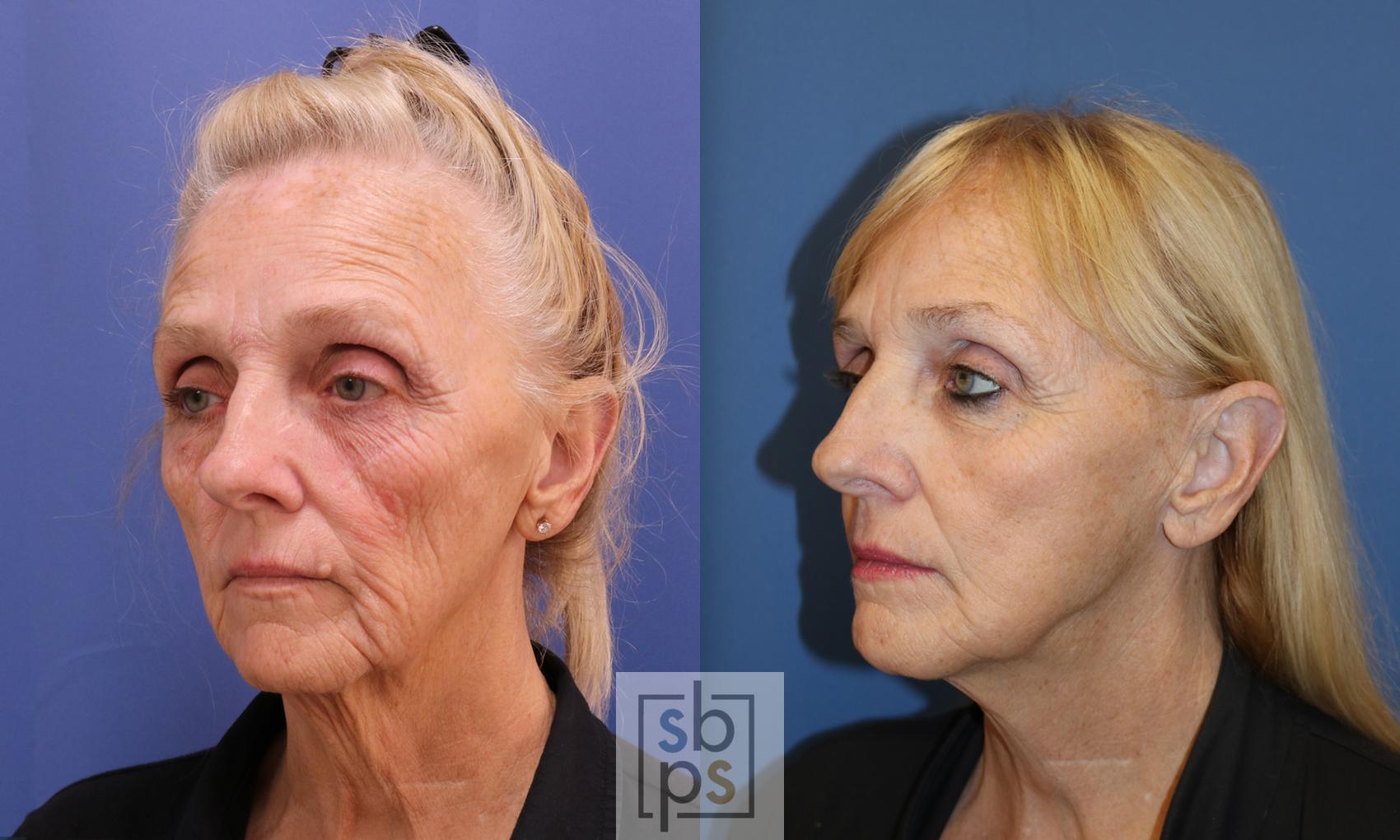 Before & After Facelift Case 345 View #3 View in Torrance & Los Angeles, CA, CA