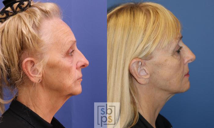 Before & After Facelift Case 345 View #4 View in Torrance, CA