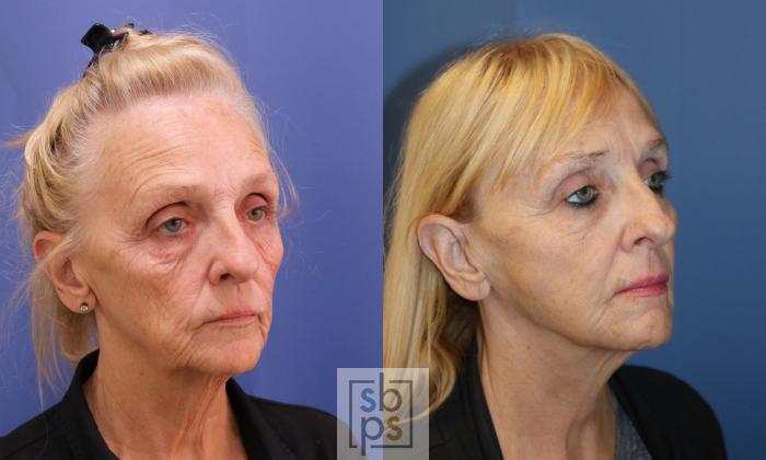 Before & After Facelift Case 345 View #5 View in Torrance, CA