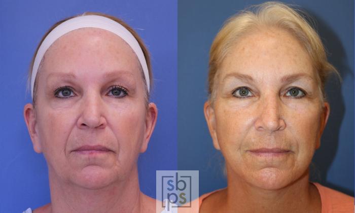 Before & After Facelift Case 393 Front View in Torrance, CA