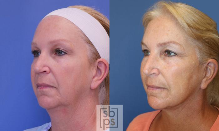 Before & After Facelift Case 393 Left Oblique View in Torrance, CA