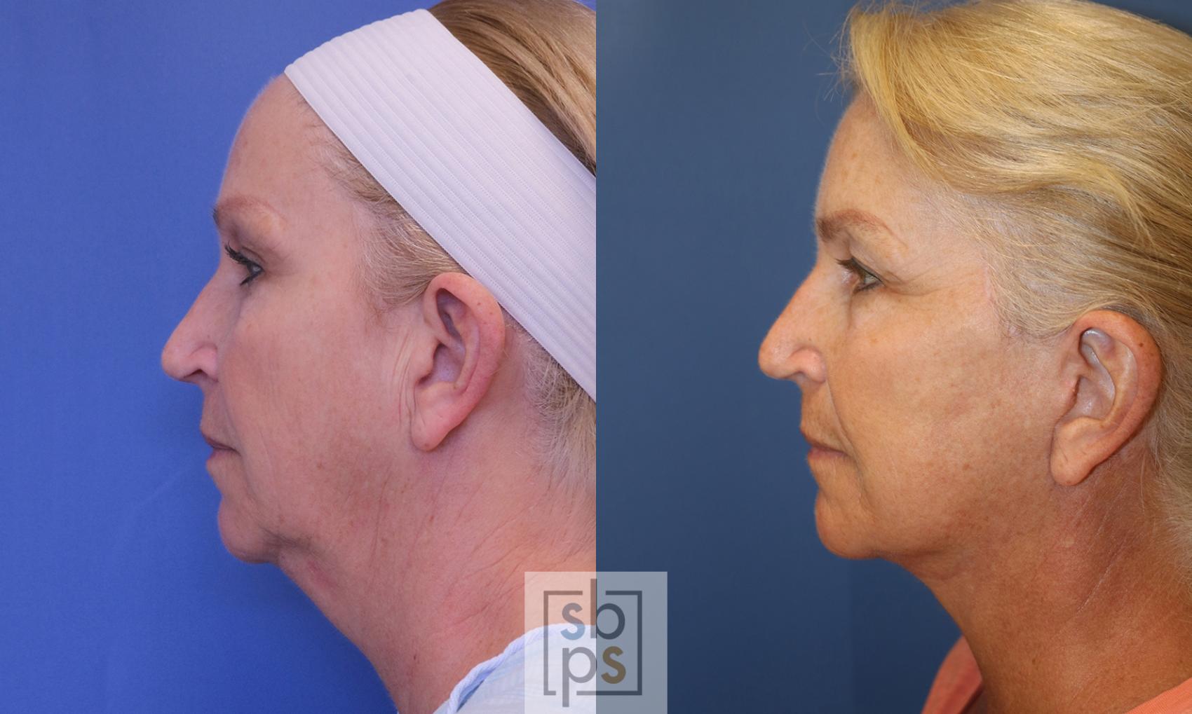 Before & After Facelift Case 393 Left Side View in Torrance & Los Angeles, CA, CA