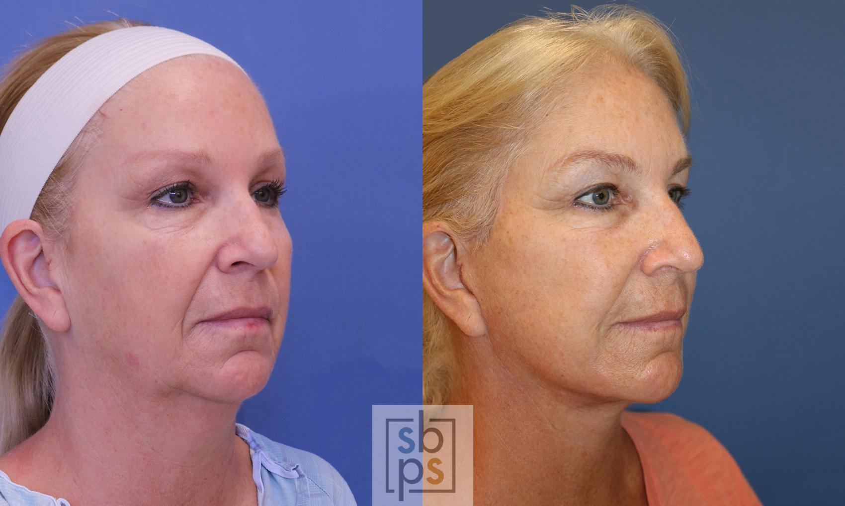Before & After Facelift Case 393 Right Oblique View in Torrance & Los Angeles, CA, CA