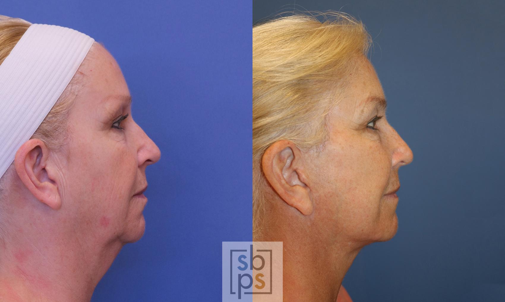 Before & After Facelift Case 393 Right Side View in Torrance & Los Angeles, CA, CA
