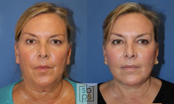 Before & After Facelift Case 443 Front View in Torrance, CA