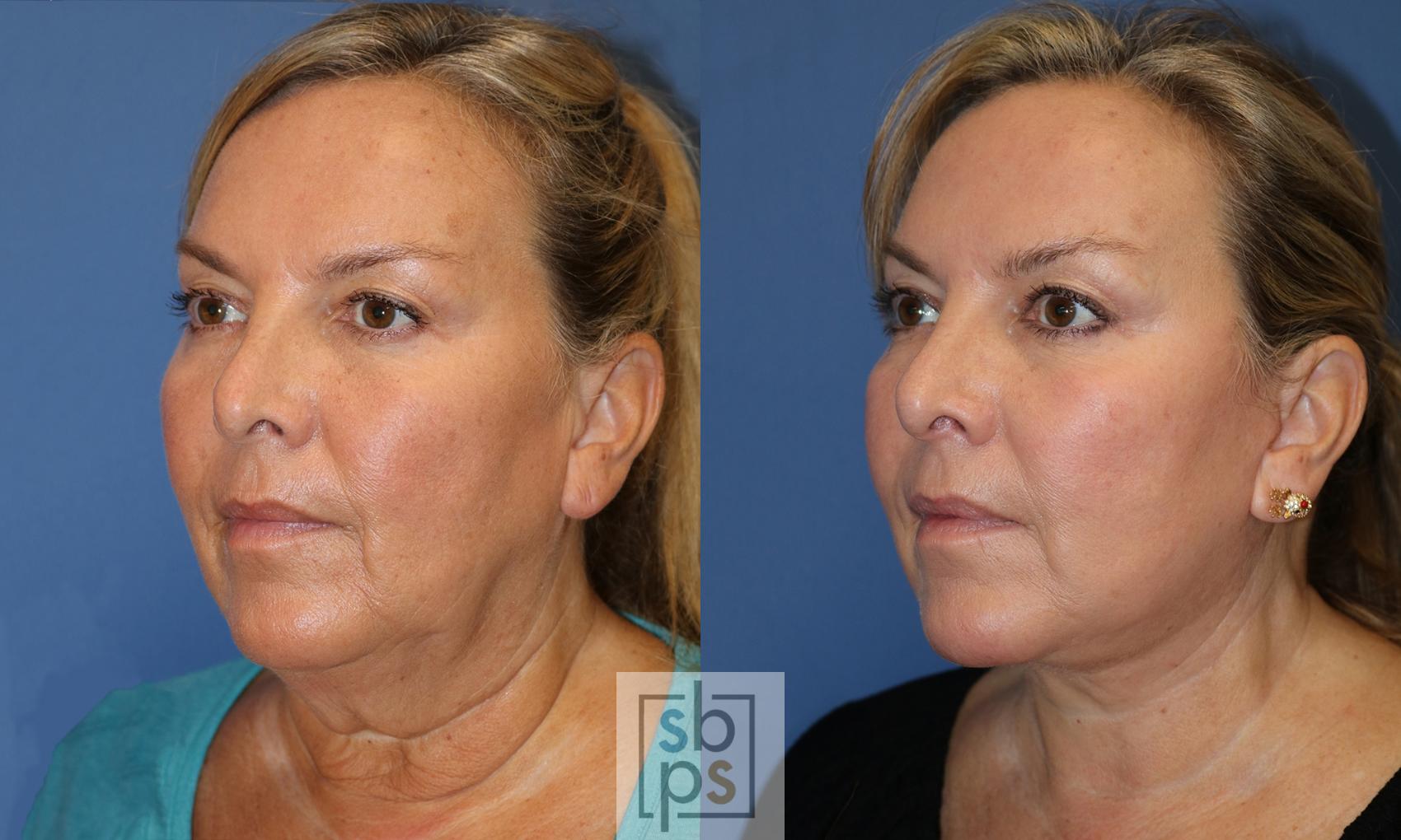 Before & After Facelift Case 443 Left Oblique View in Torrance, CA