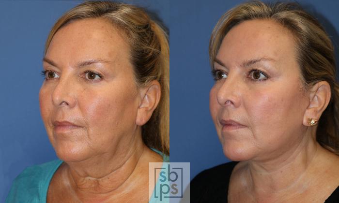 Before & After Neck Lift Case 443 Left Oblique View in Torrance, CA
