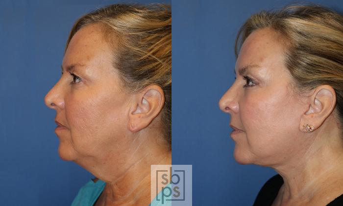 Before & After Neck Lift Case 443 Left Side View in Torrance, CA