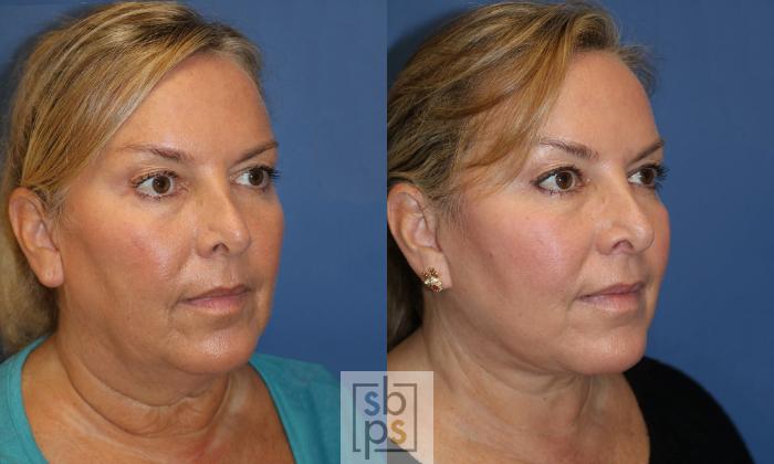 Before & After Neck Lift Case 443 Right Oblique View in Torrance, CA