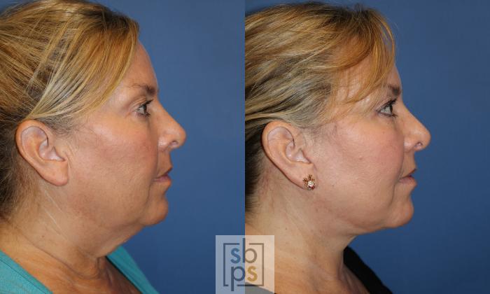 Before & After Neck Lift Case 443 Right Side View in Torrance, CA