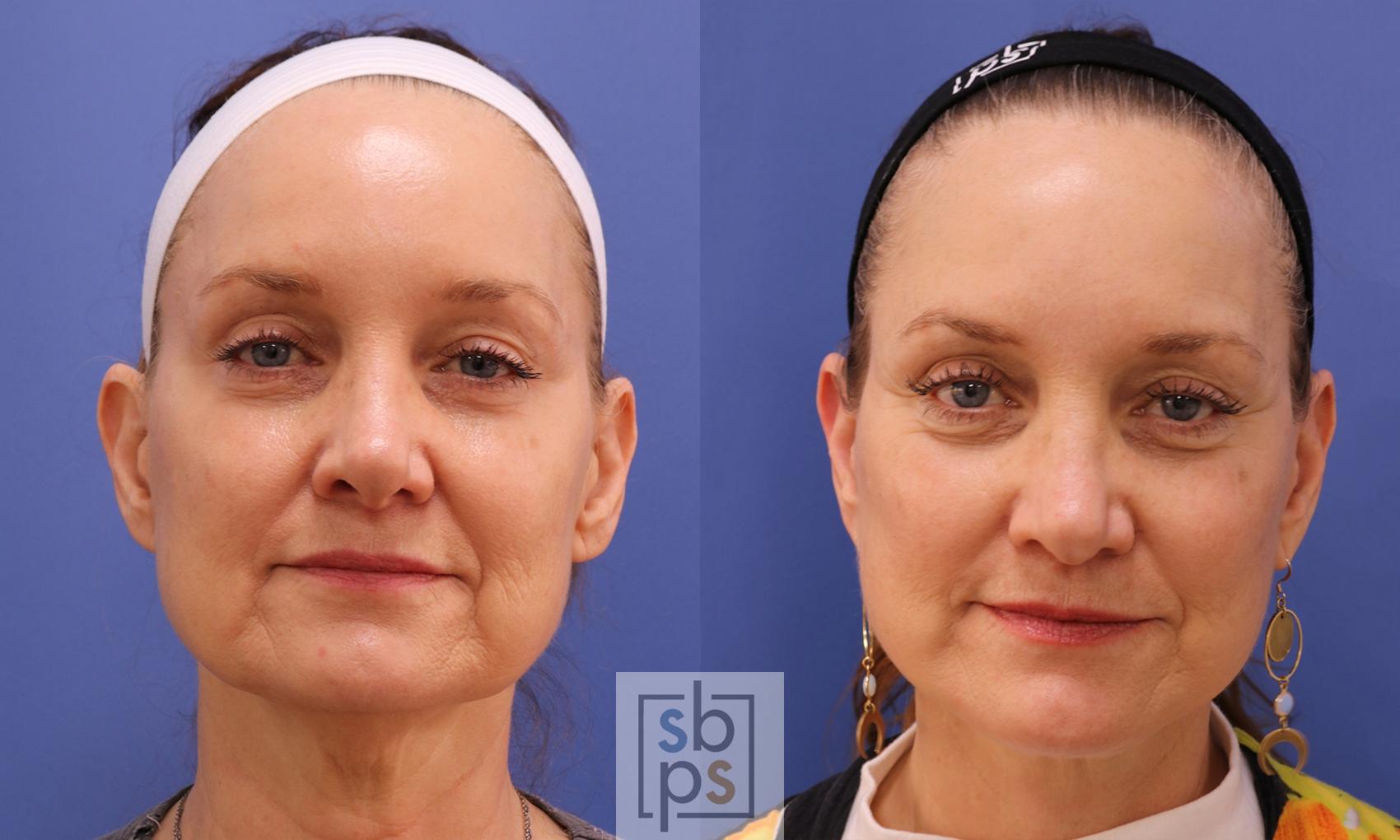 Before & After Facelift Case 458 Front View in Los Angeles & Torrance, CA, CA