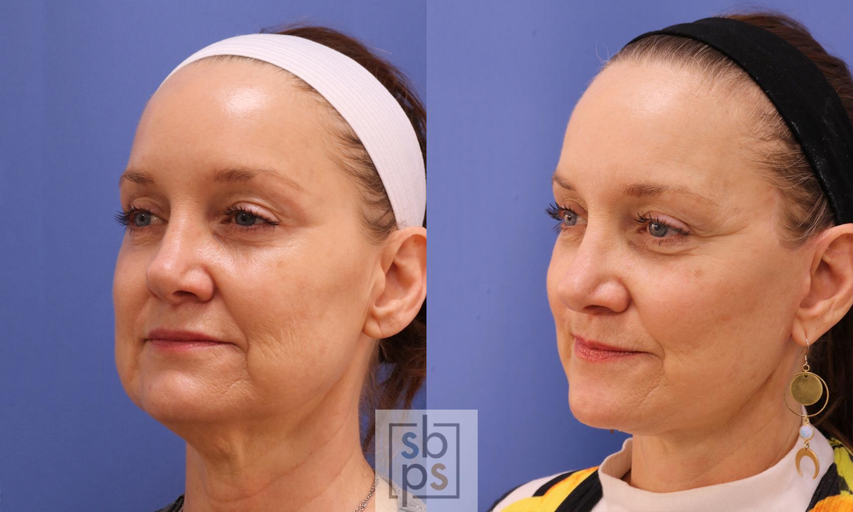 Before & After Facelift Case 458 Left Oblique View in Torrance & Los Angeles, CA, CA