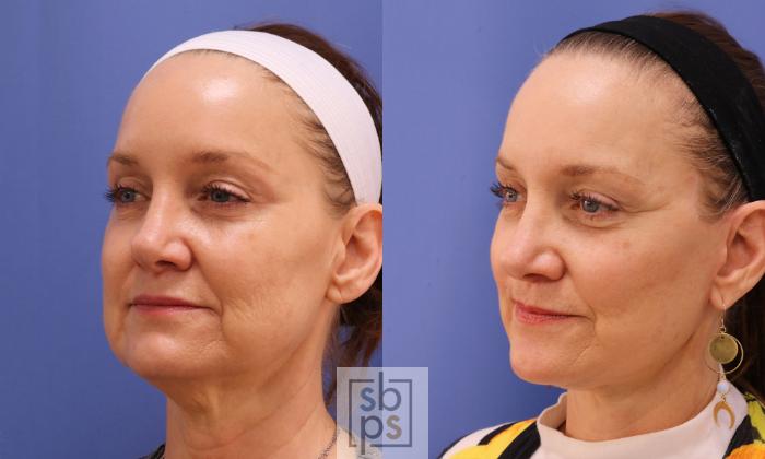 Before & After Facelift Case 458 Left Oblique View in Torrance, CA