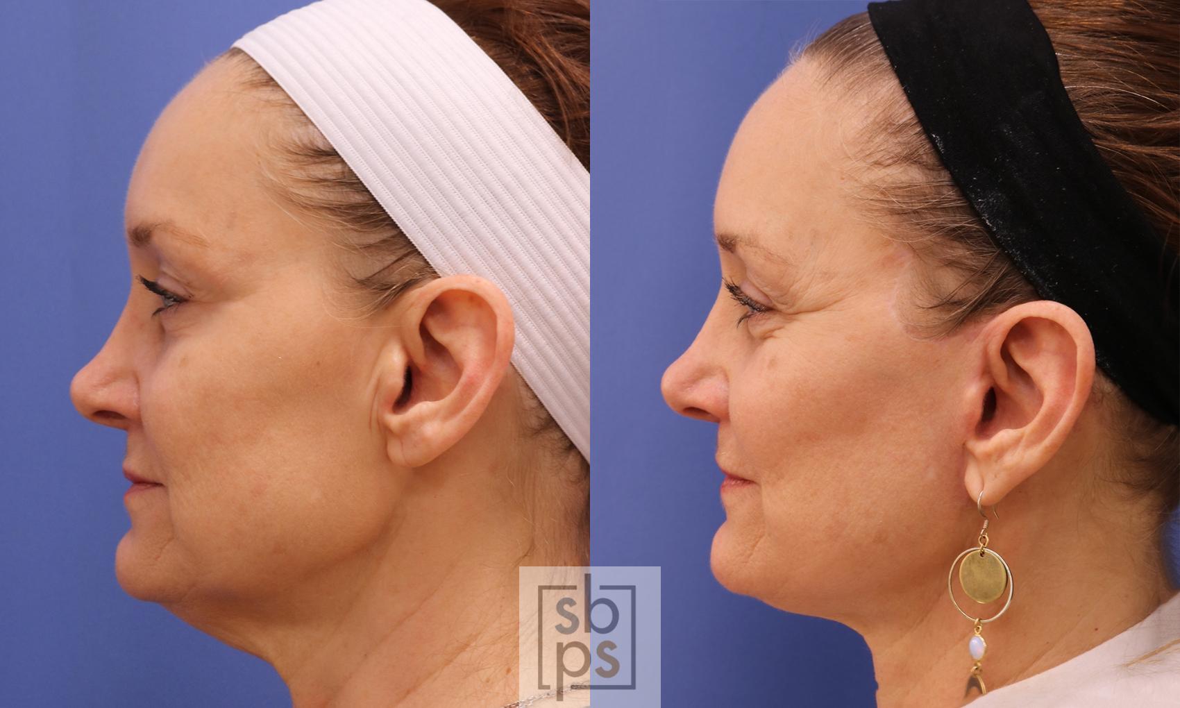 Before & After Facelift Case 458 Left Side View in Torrance & Los Angeles, CA, CA