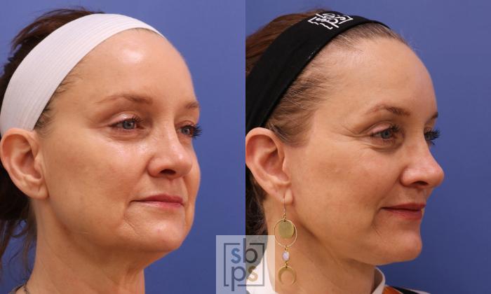 Before & After Facelift Case 458 Right Oblique View in Torrance, CA