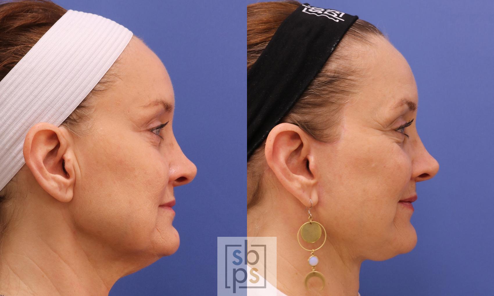 Before & After Facelift Case 458 Right Side View in Torrance & Los Angeles, CA, CA