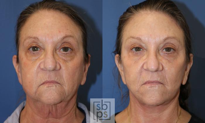 Before & After Facelift Case 485 Front View in Torrance, CA