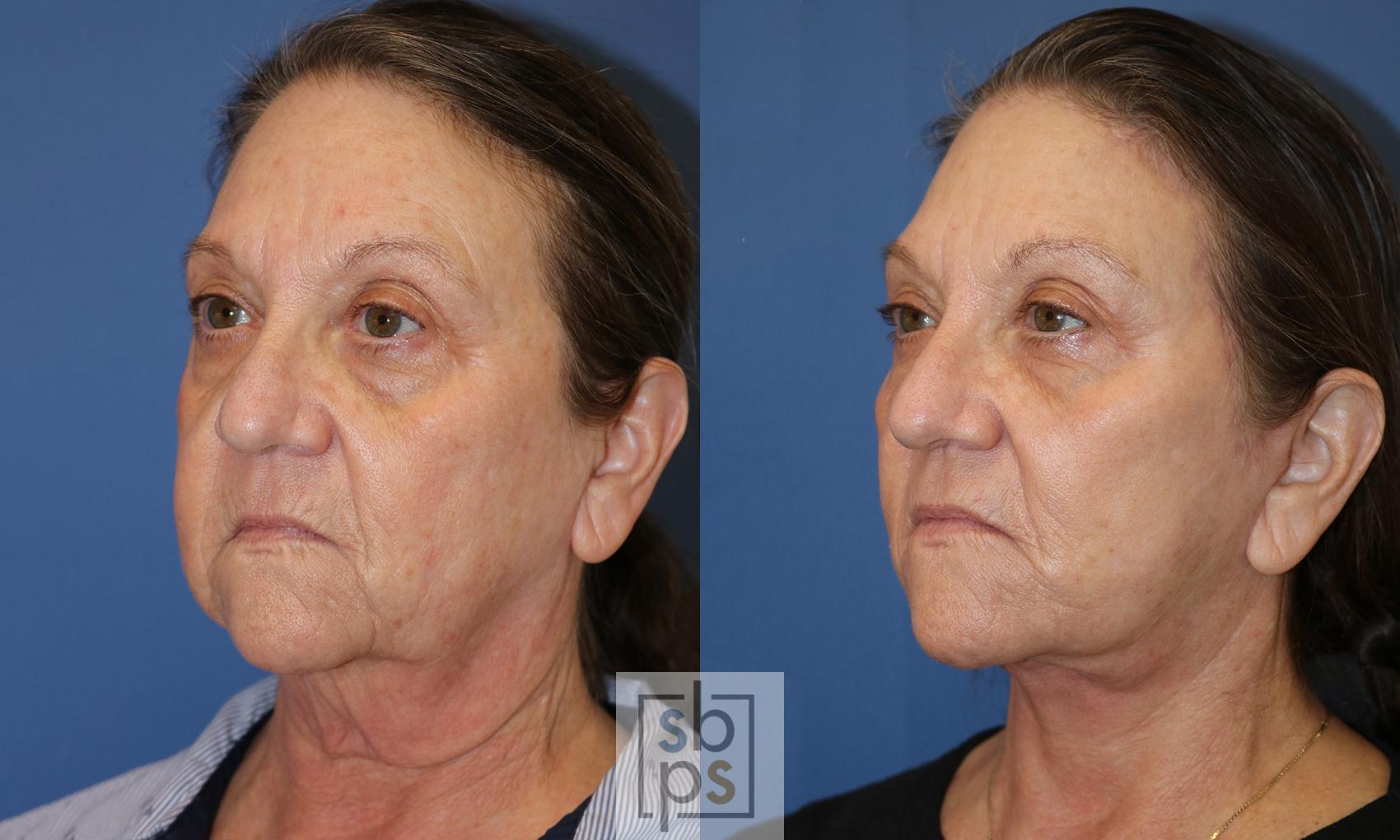 Before & After Facelift Case 485 Left Oblique View in Torrance & Los Angeles, CA, CA