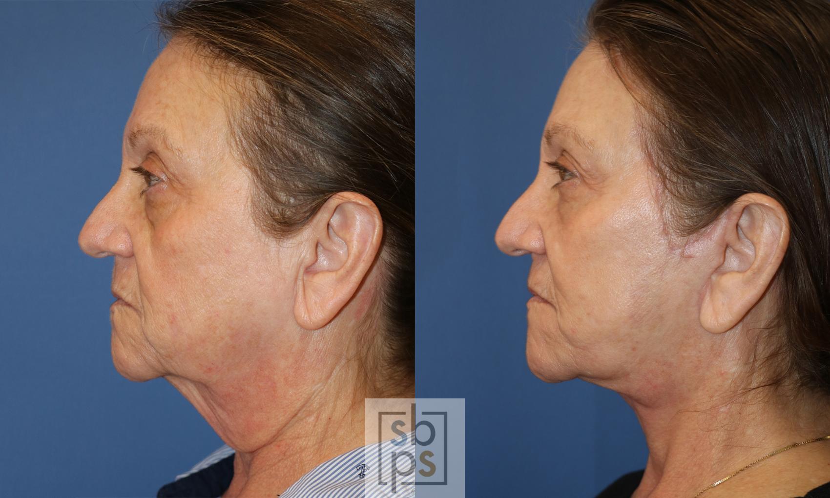 Before & After Facelift Case 485 Left Side View in Torrance & Los Angeles, CA, CA