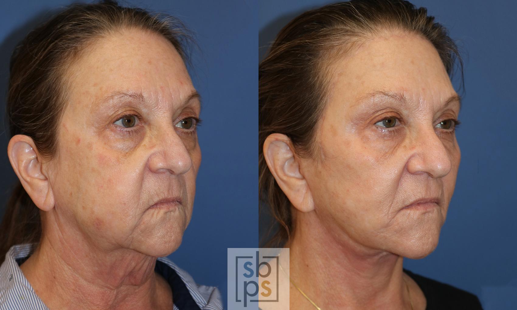 Before & After Facelift Case 485 Right Oblique View in Los Angeles & Torrance, CA, CA