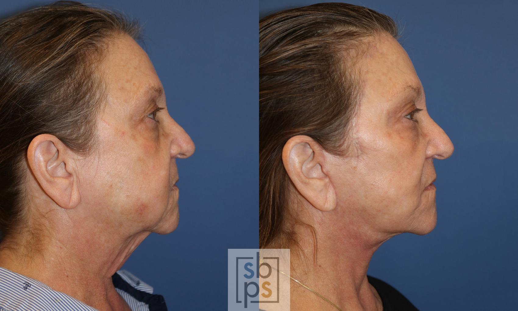 Before & After Facelift Case 485 Right Side View in Torrance & Los Angeles, CA, CA
