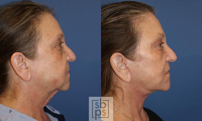 Before & After Facelift Case 485 Right Side View in Torrance, CA