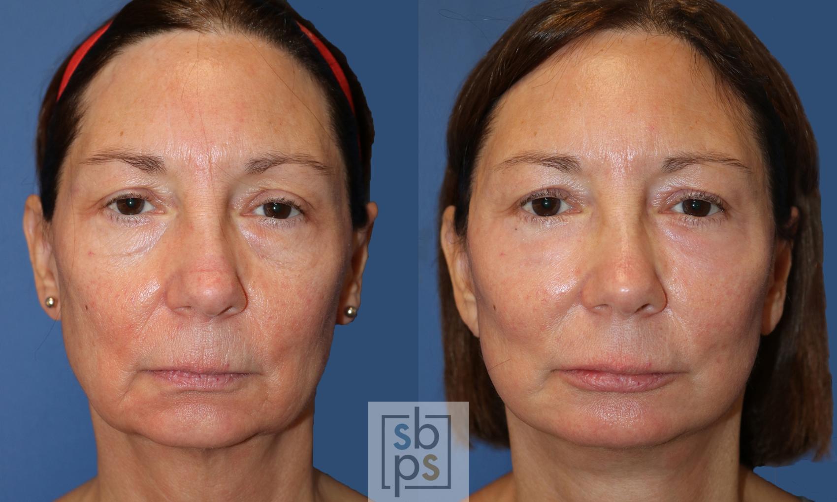 Before & After Facelift Case 494 Front View in Torrance, CA