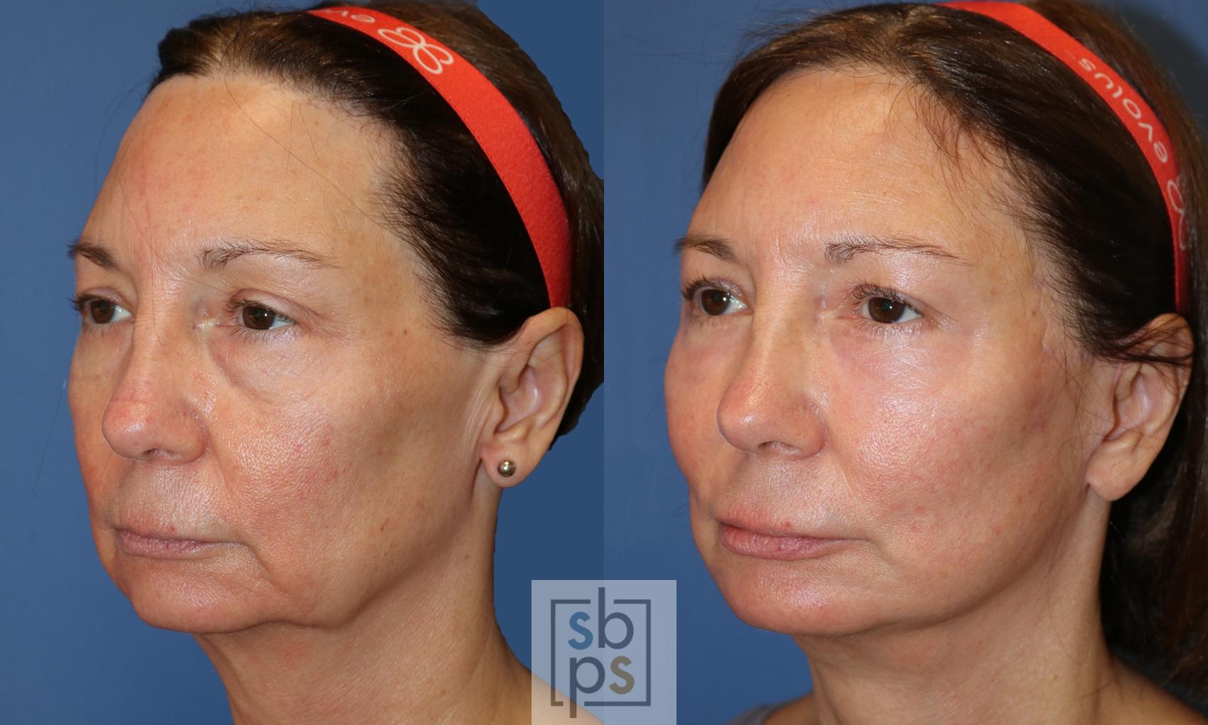 Before & After Fat Injection Case 494 Left Oblique View in Torrance & Los Angeles, CA, CA