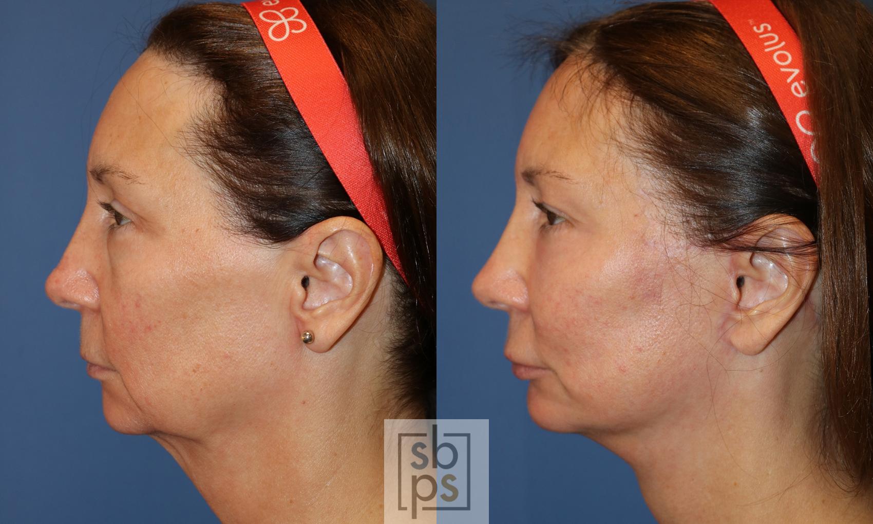 Before & After Fat Injection Case 494 Left Side View in Torrance & Los Angeles, CA, CA
