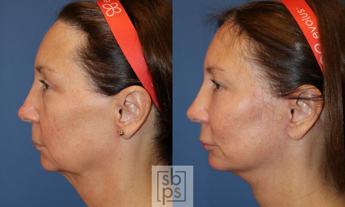 Before & After Fat Injection Case 494 Left Side View in Torrance, CA