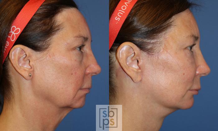 Before & After Fat Injection Case 494 Right Side View in Torrance, CA