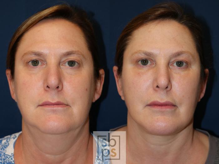Before & After Facelift Case 538 Front View in Torrance, CA