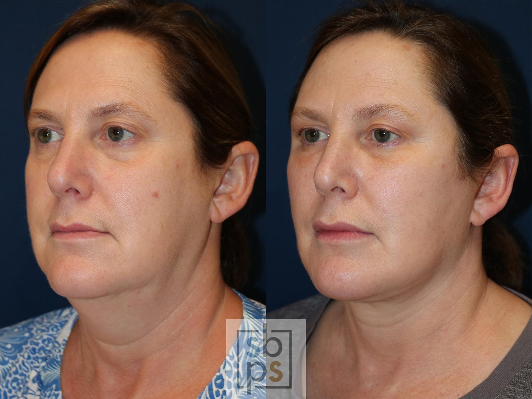 Before & After Facelift Case 538 Left Oblique View in Los Angeles & Torrance, CA, CA