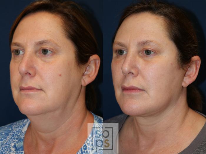 Before & After Facelift Case 538 Left Oblique View in Torrance, CA