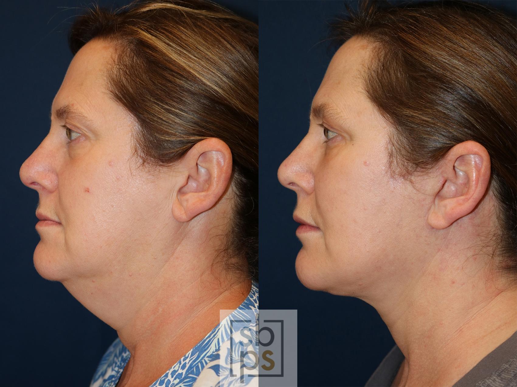 Before & After Facelift Case 538 Left Side View in Torrance & Los Angeles, CA, CA
