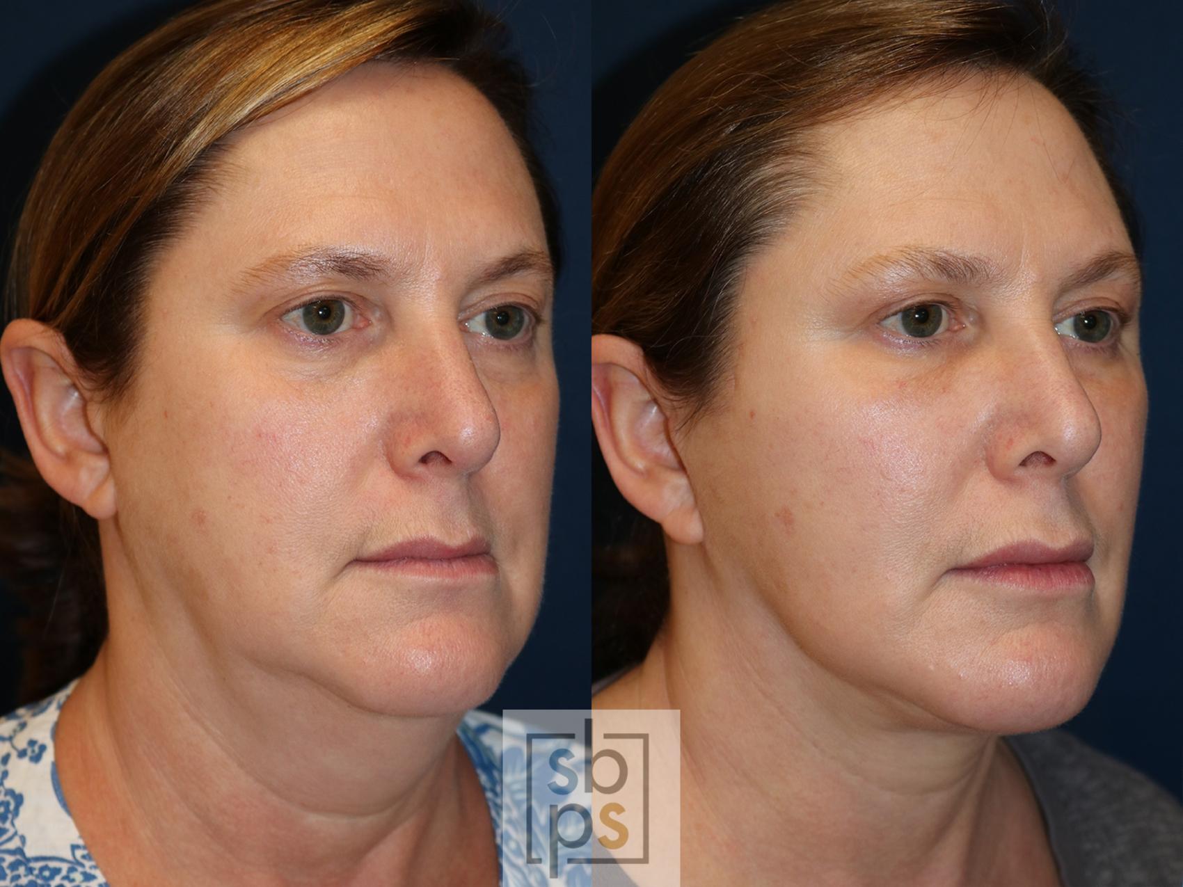 Before & After Facelift Case 538 Right Oblique View in Torrance & Los Angeles, CA, CA