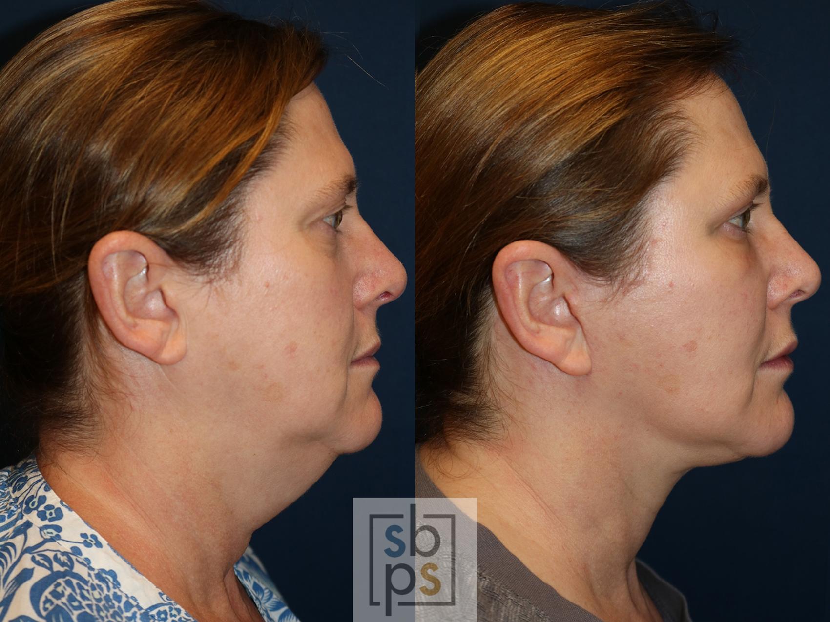 Before & After Facelift Case 538 Right Side View in Torrance & Los Angeles, CA, CA
