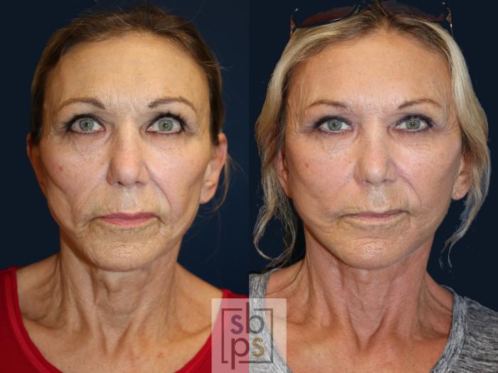 Before & After Facelift Case 637 Front View in Torrance, CA