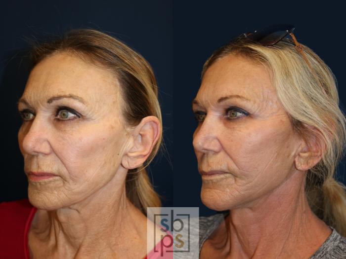 Before & After Facelift Case 637 Left Oblique View in Torrance, CA