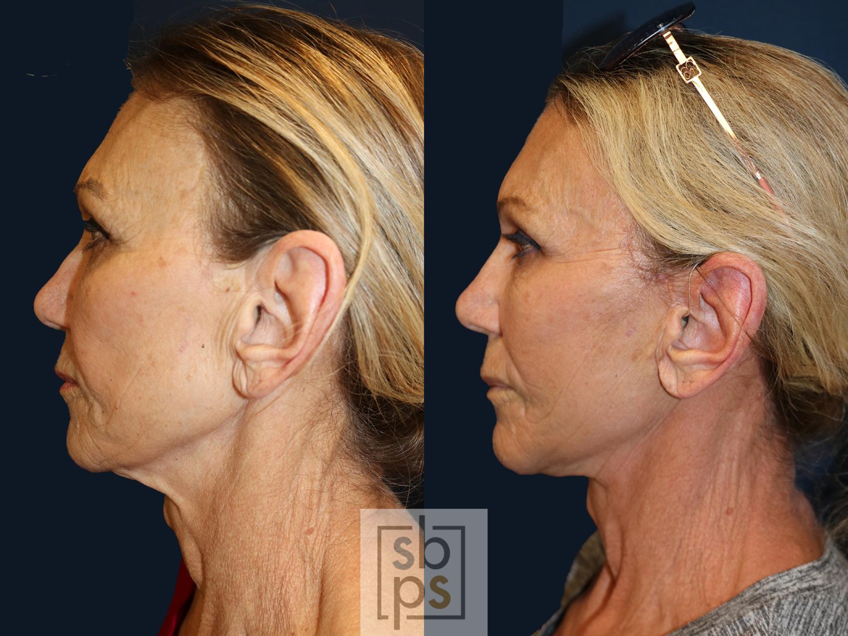 Before & After Facelift Case 637 Left Side View in Torrance & Los Angeles, CA, CA