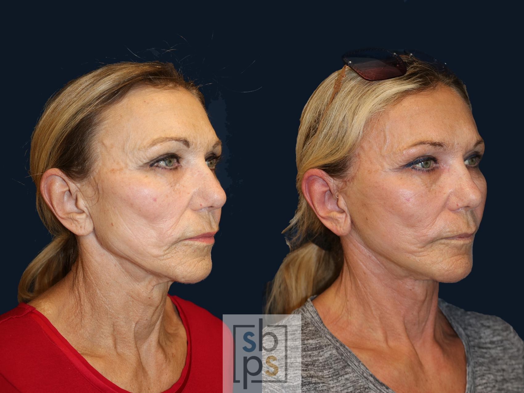 Before & After Facelift Case 637 Right Oblique View in Torrance & Los Angeles, CA, CA