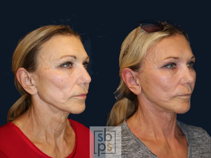 Before & After Facelift Case 637 Right Oblique View in Torrance, CA