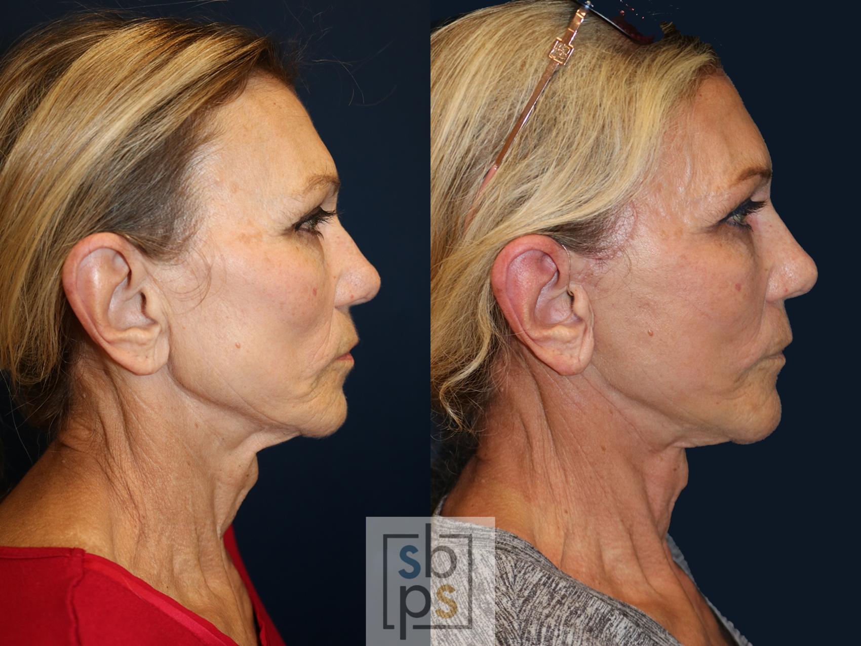 Before & After Facelift Case 637 Right Side View in Torrance & Los Angeles, CA, CA
