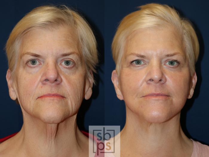 Before & After Facelift Case 682 Front View in Torrance, CA