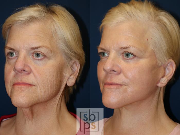 Before & After Facelift Case 682 Left Oblique View in Torrance, CA