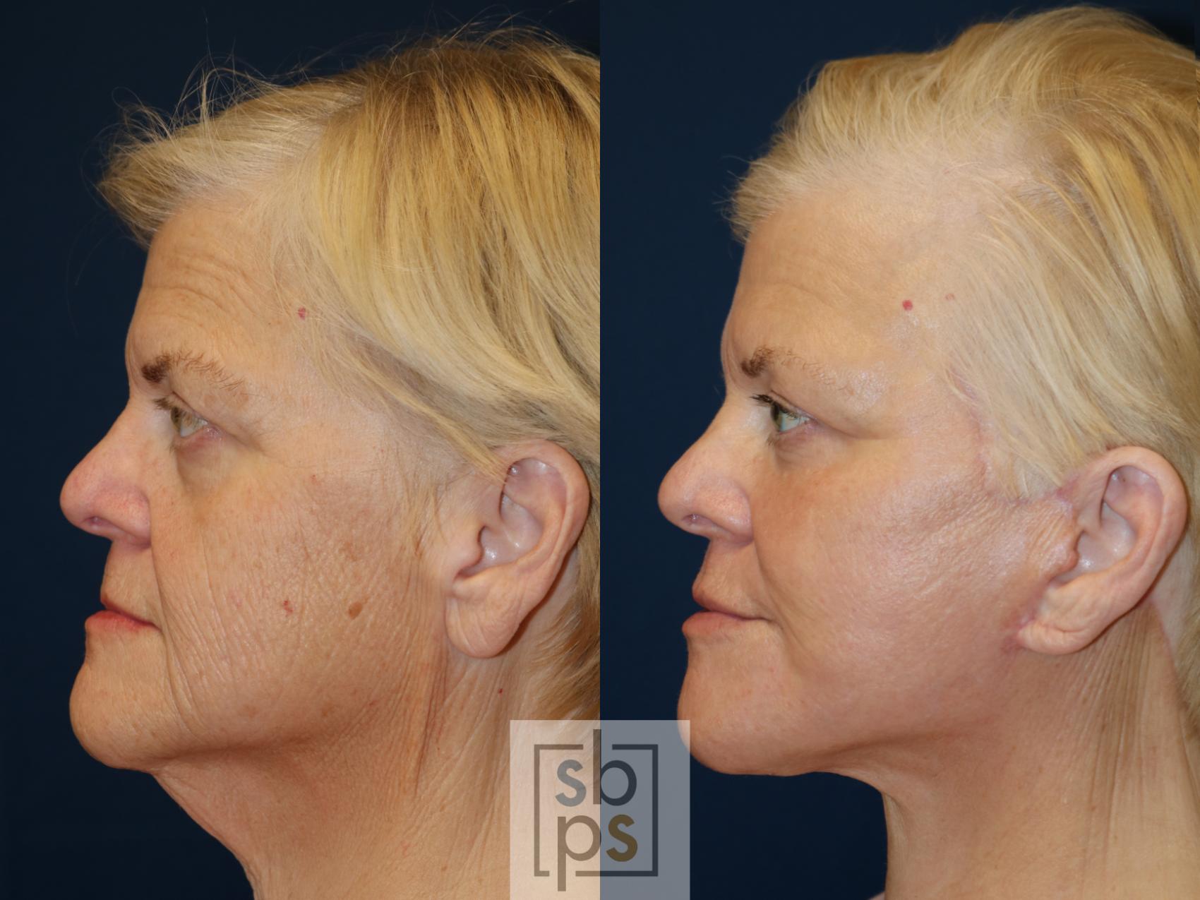 Before & After Facelift Case 682 Left Side View in Torrance & Los Angeles, CA, CA