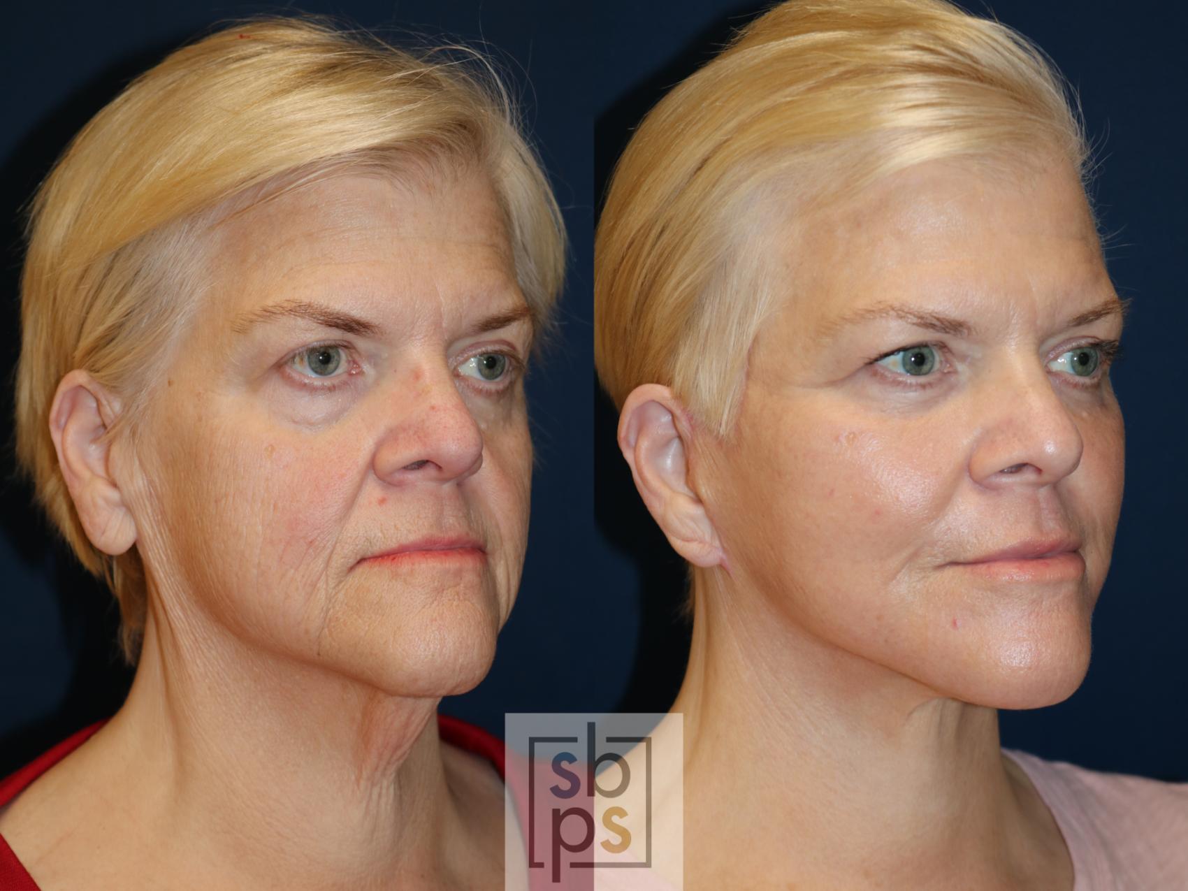 Before & After Facelift Case 682 Right Oblique View in Torrance & Los Angeles, CA, CA