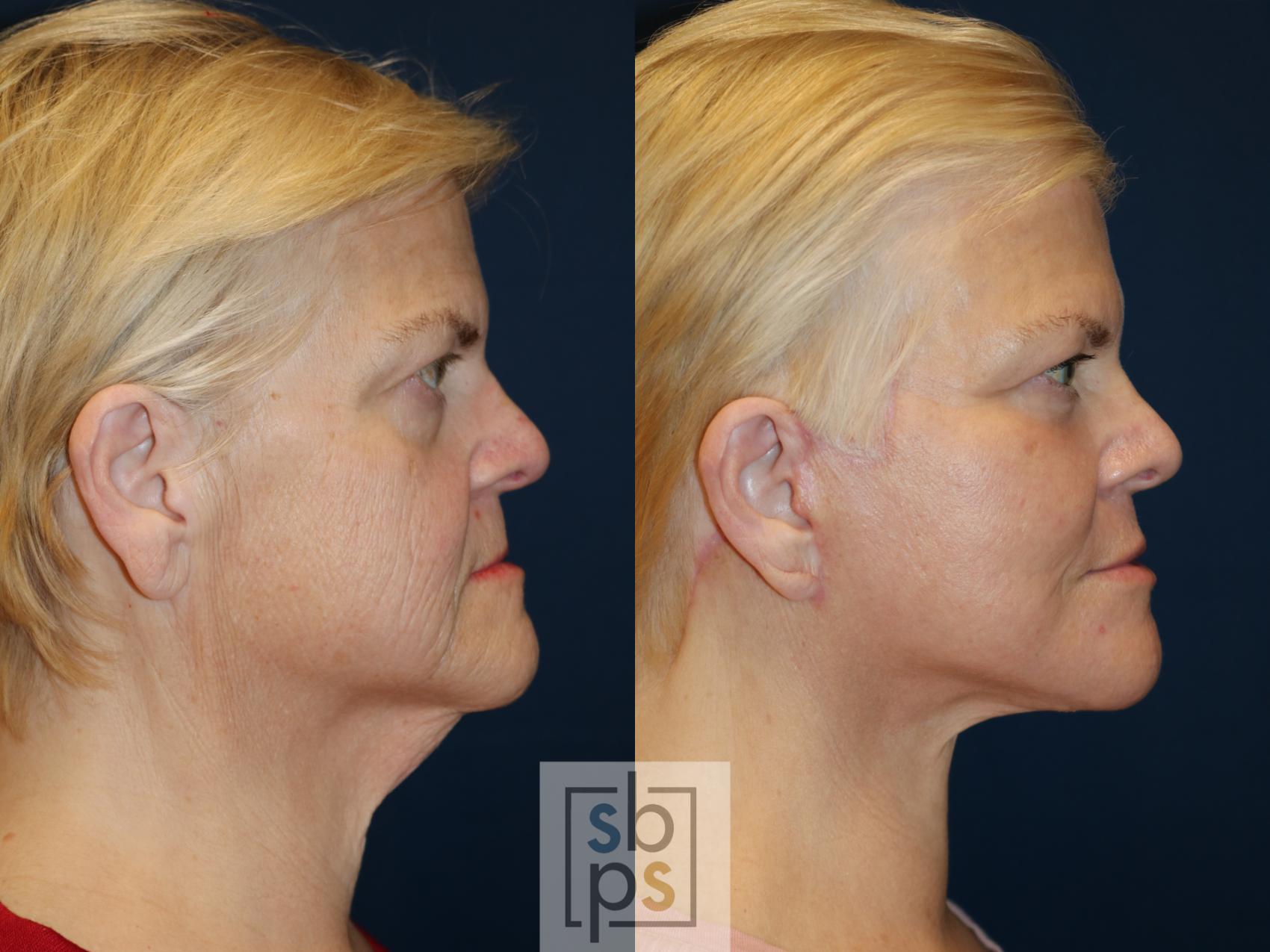 Before & After Facelift Case 682 Right Side View in Torrance & Los Angeles, CA, CA
